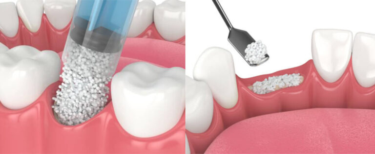 biomaterial-dental