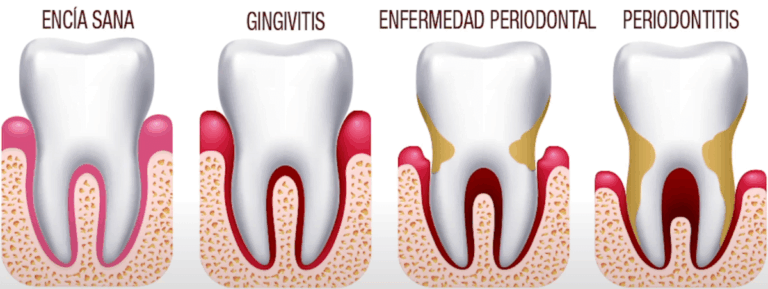 comparacion de encias sanas y retraidas