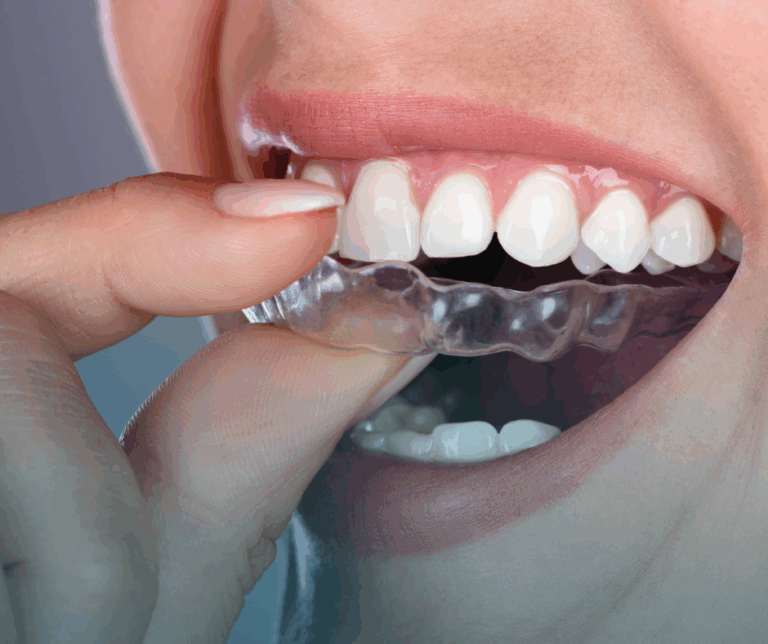 ferula-para-el-bruxismo.