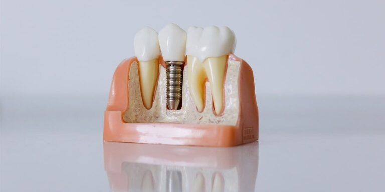 implantes-carga-inmediata