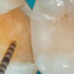 Primer plano de dos molares, uno de ellos con una caries que se está limpiando o midiendo con una sonda dental, mostrando la preparación para un empaste dental. -corvt_ar