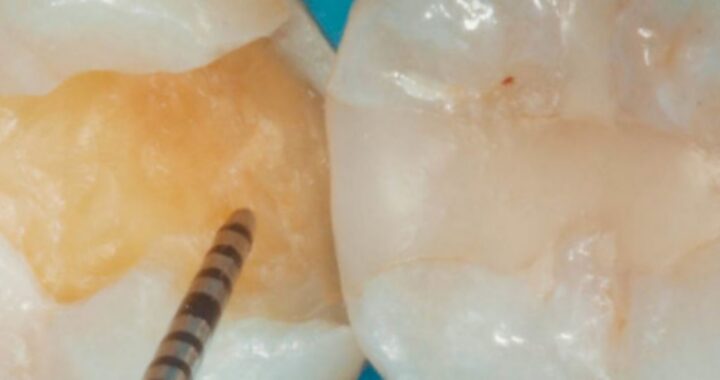 Primer plano de dos molares, uno de ellos con una caries que se está limpiando o midiendo con una sonda dental, mostrando la preparación para un empaste dental. -corvt_ar