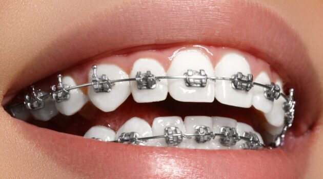tipos-de-brackets